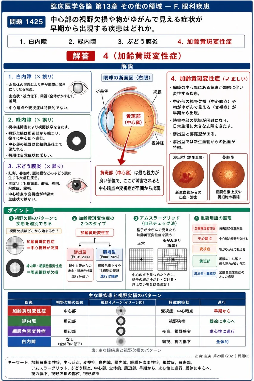 鍼灸 第29回(2021) 問題62｜中心部の視野欠損や物がゆがんで見える症状が早期から出現する疾患はどれか。 解説図