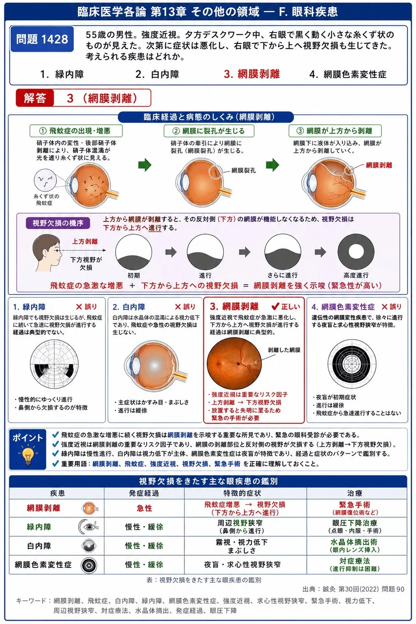 鍼灸 第30回(2022) 問題90｜「55歳の男性。強度近視。夕方デスクワーク中、右眼で黒く動く小さな糸くず状のものが見えた。」次第に症状は悪化し、右眼で下から上へ視野欠損も生じてきた。考えられる疾患はどれか。 解説図