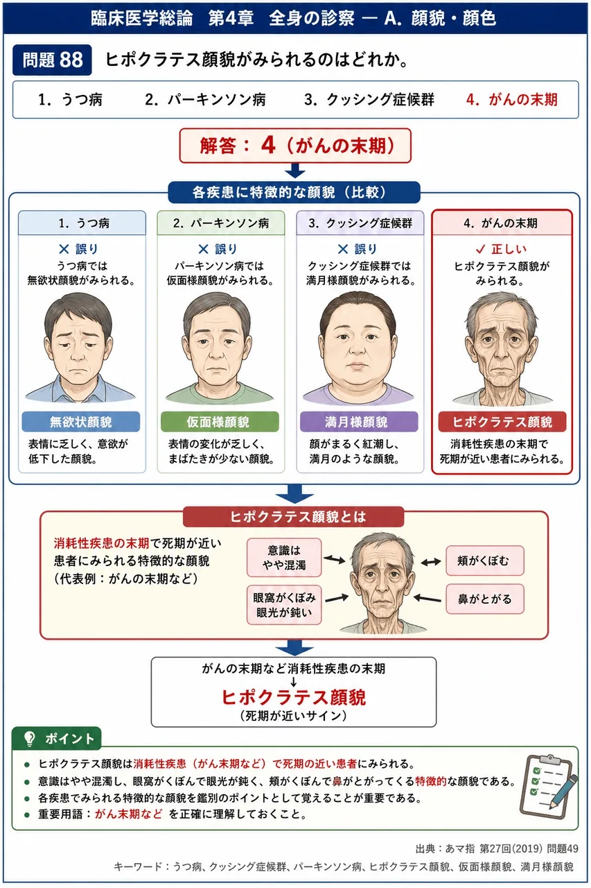 あマ指 第27回(2019) 問題49｜ヒポクラテス顔貌がみられるのはどれか。 解説図