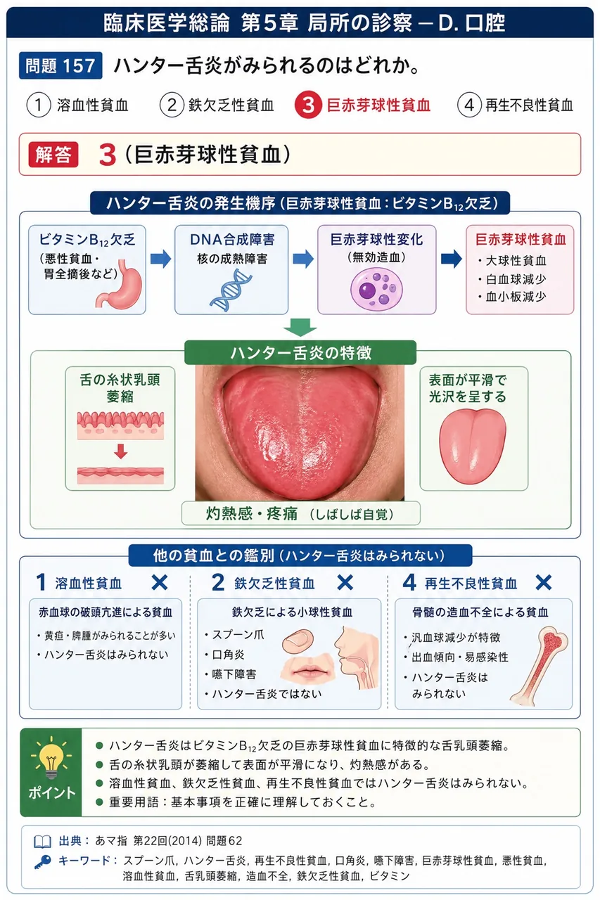 あマ指 第22回(2014) 問題62｜ハンター舌炎がみられるのはどれか。 解説図