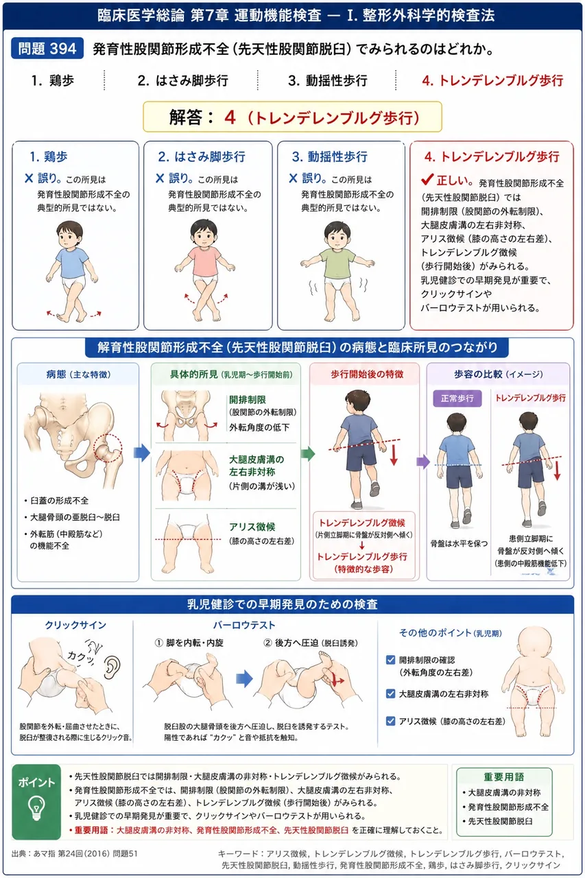 あマ指 第24回(2016) 問題51｜発育性股関節形成不全(先天性股関節脱臼)でみられるのはどれか。 解説図