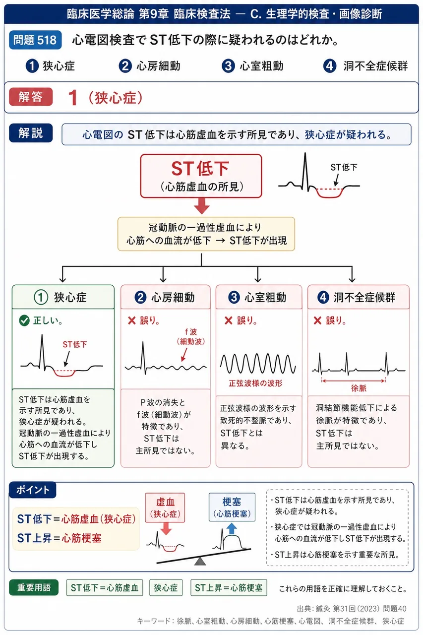 鍼灸 第31回(2023) 問題40｜心電図検査で ST低下の際に疑われるのはどれか。 解説図
