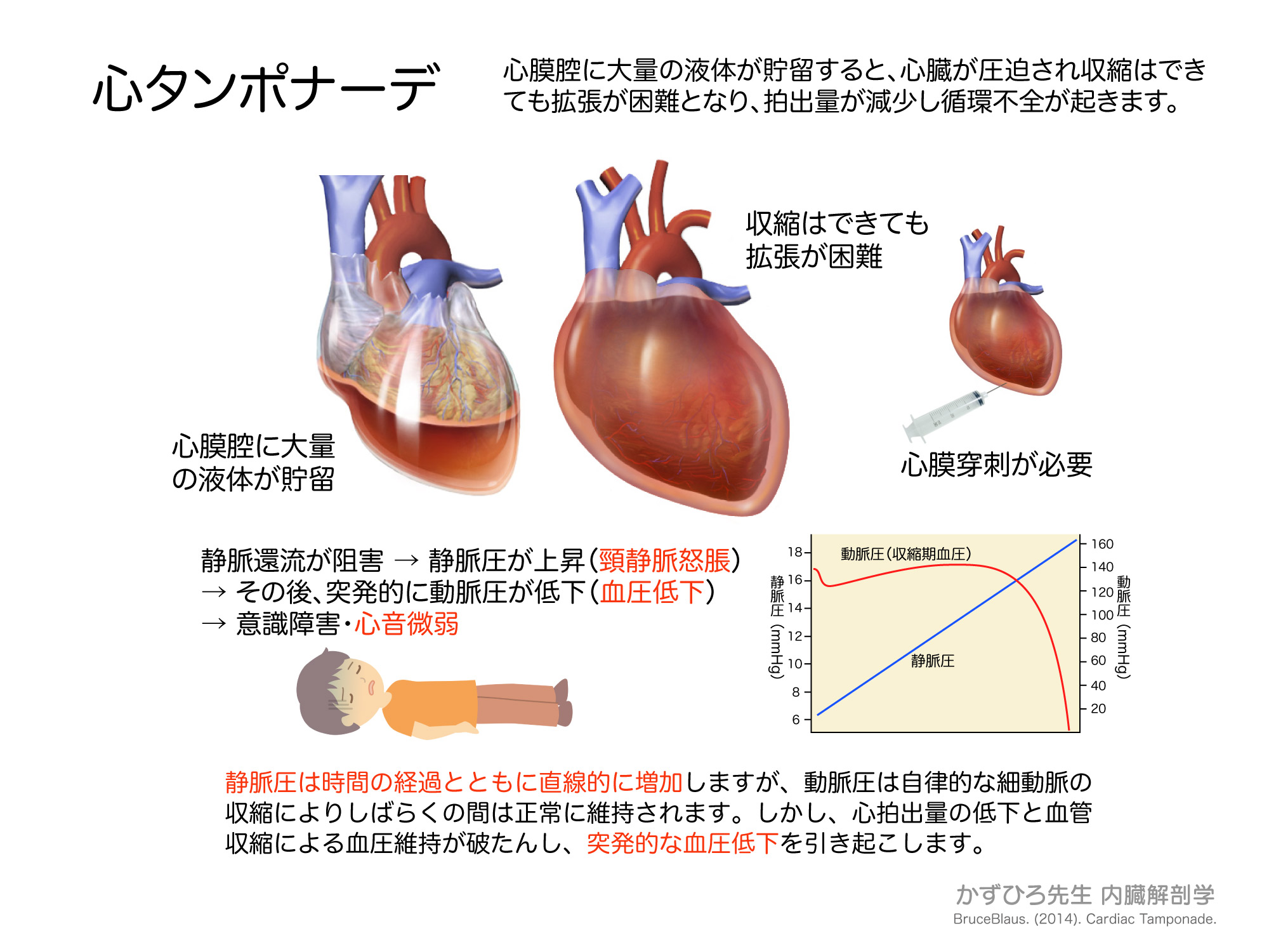 心タンポナーデ